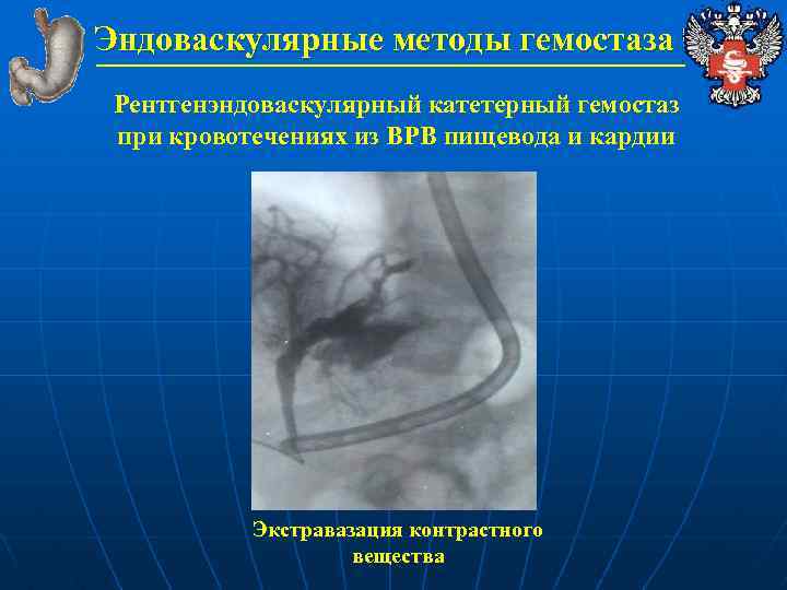 Эндоваскулярные методы гемостаза Рентгенэндоваскулярный катетерный гемостаз при кровотечениях из ВРВ пищевода и кардии Экстравазация