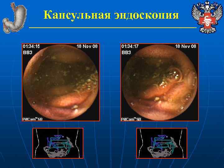 Капсульная эндоскопия 