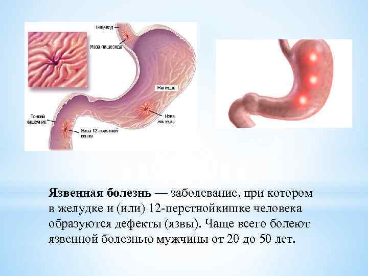 Язвенная болезнь — заболевание, при котором в желудке и (или) 12 перстнойкишке человека образуются