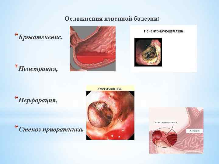  Осложнения язвенной болезни: *Кровотечение, *Пенетрация, *Перфорация, *Стеноз привратника. 