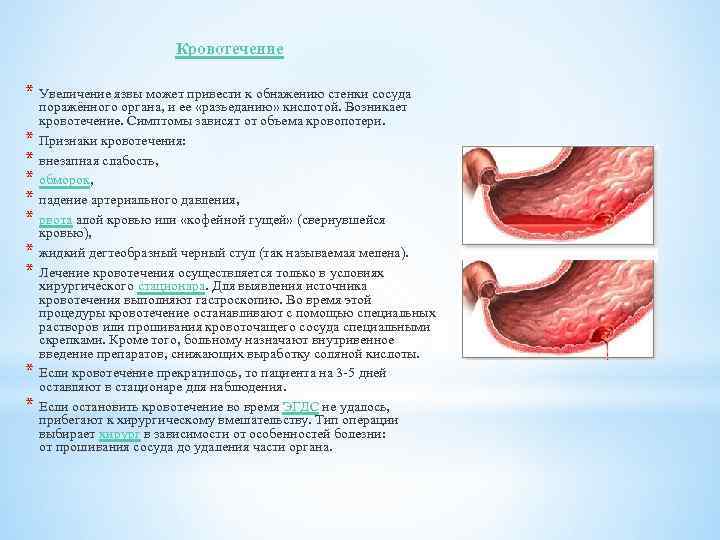 Кровотечение * Увеличение язвы может привести к обнажению стенки сосуда * * * *