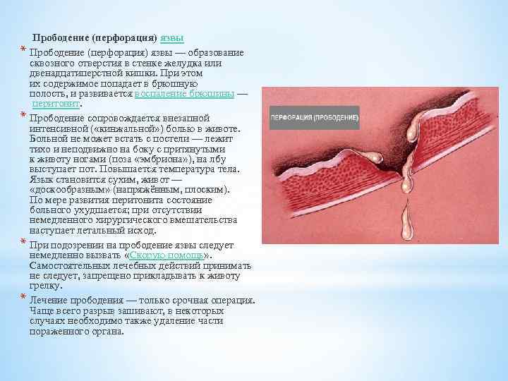 * * Прободение (перфорация) язвы — образование сквозного отверстия в стенке желудка или двенадцатиперстной