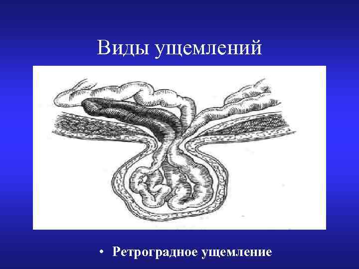 Виды ущемлений • Ретроградное ущемление 