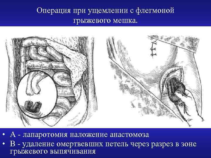 Операция при ущемлении с флегмоной грыжевого мешка. • А - лапаротомия наложение анастомоза •