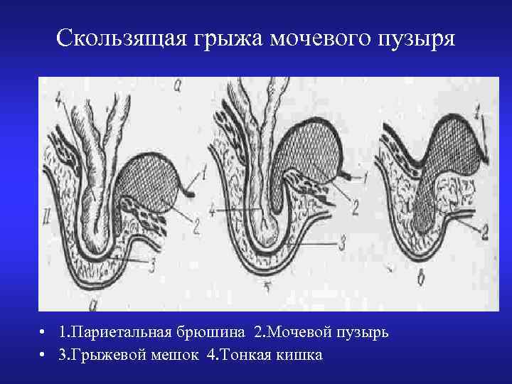 Скользящая грыжа мочевого пузыря • 1. Париетальная брюшина 2. Мочевой пузырь • 3. Грыжевой