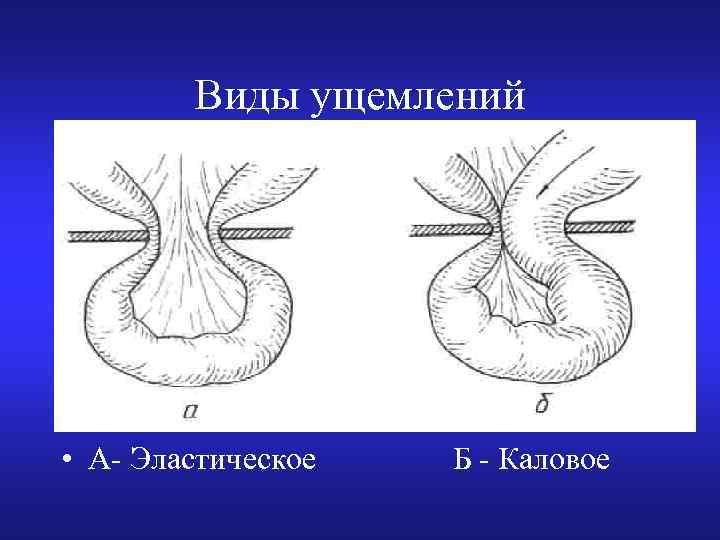 Виды ущемлений • А- Эластическое Б - Каловое 