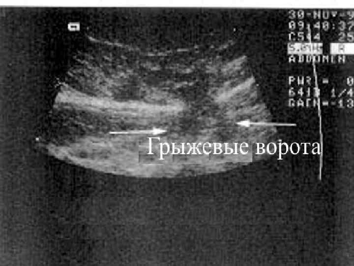 Паховая грыжа у женщин фото на узи как выглядит