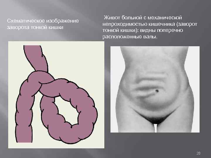 Схематическое изображение заворота тонкой кишки Живот больной с механической непроходимостью кишечника (заворот тонкой кишки):
