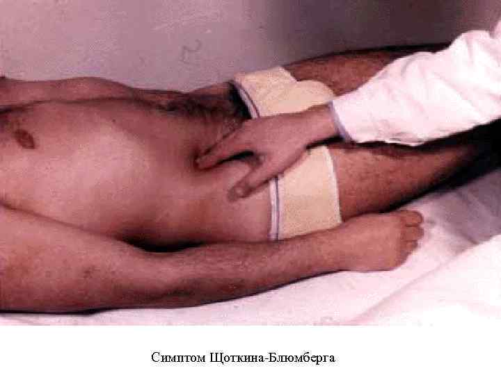 Симптом Щоткина Блюмберга 