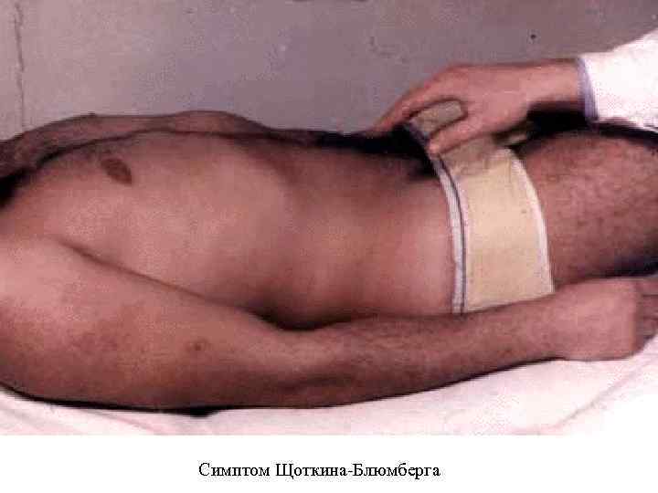 Симптом Щоткина Блюмберга 