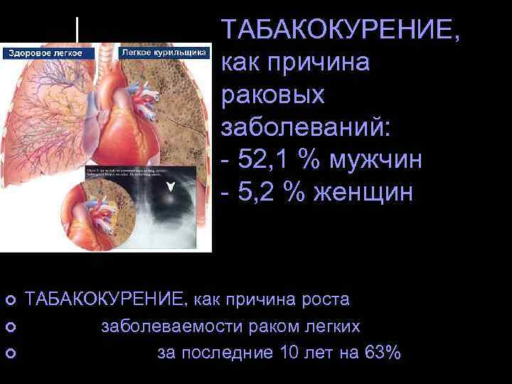 ТАБАКОКУРЕНИЕ, как причина раковых заболеваний: - 52, 1 % мужчин - 5, 2 %
