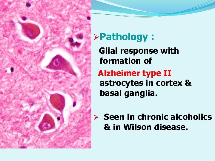 ØPathology : Glial response with formation of Alzheimer type II astrocytes in cortex &