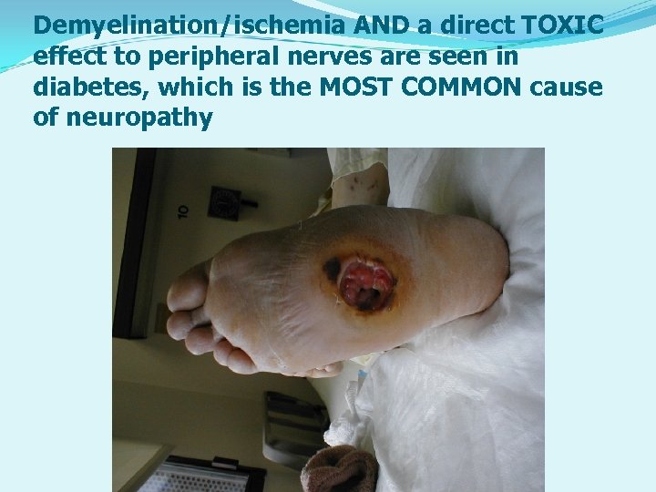 Demyelination/ischemia AND a direct TOXIC effect to peripheral nerves are seen in diabetes, which