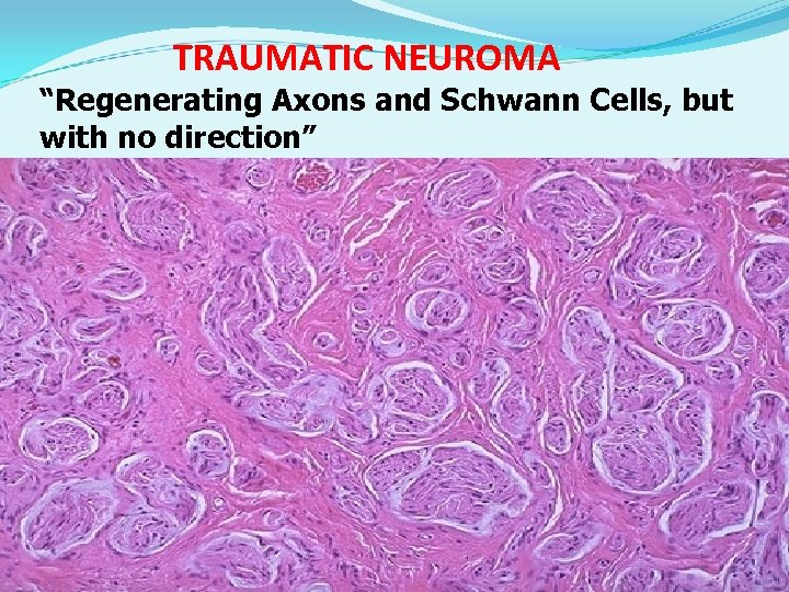 TRAUMATIC NEUROMA “Regenerating Axons and Schwann Cells, but with no direction” 