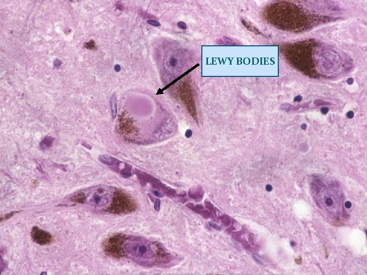 LEWY BODIES 