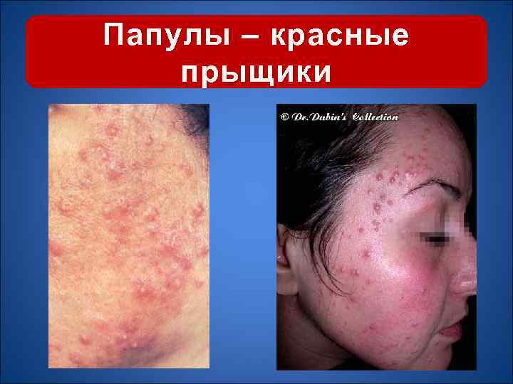 Папулы – красные прыщики 