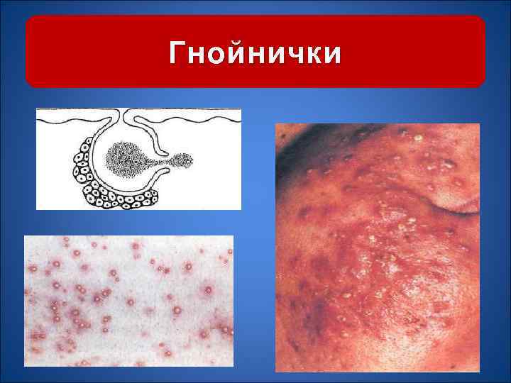 Гнойнички 