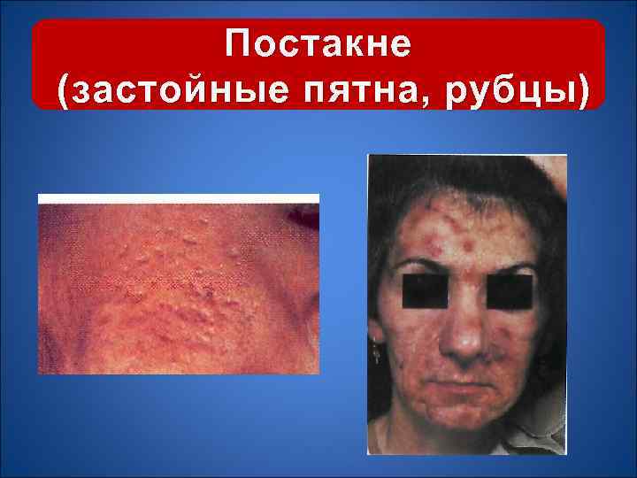 Постакне (застойные пятна, рубцы) 