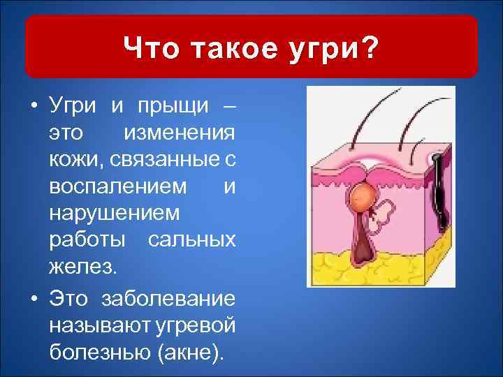 Что такое угри? • Угри и прыщи – это изменения кожи, связанные с воспалением