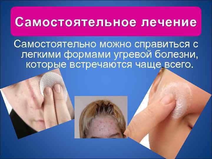 Самостоятельное лечение Самостоятельно можно справиться с легкими формами угревой болезни, которые встречаются чаще всего.