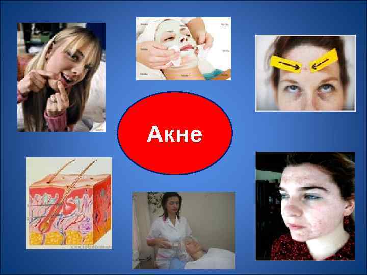 Акне 