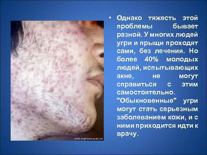  • Однако тяжесть этой проблемы бывает разной. У многих людей угри и прыщи