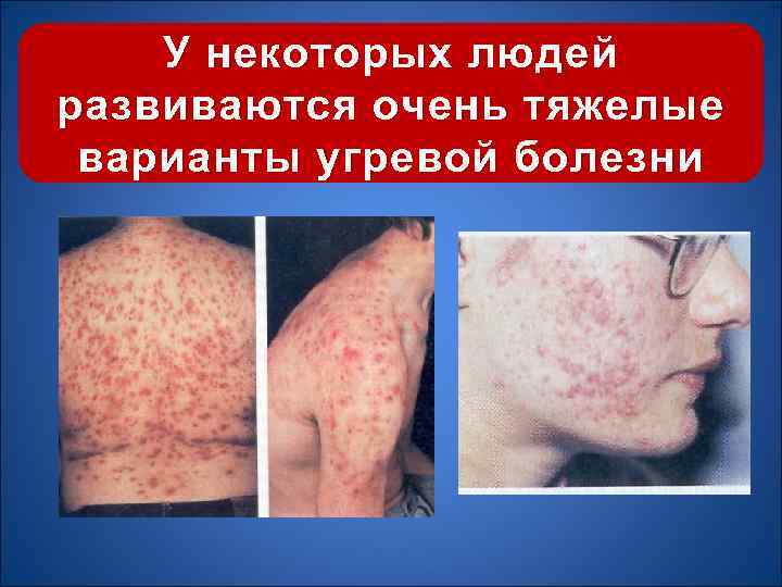 У некоторых людей развиваются очень тяжелые варианты угревой болезни 