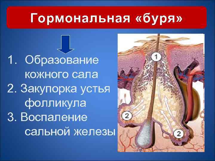 Гормональная «буря» 1. Образование кожного сала 2. Закупорка устья фолликула 3. Воспаление сальной железы