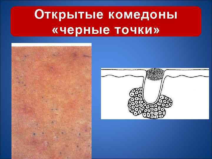 Открытые комедоны «черные точки» 