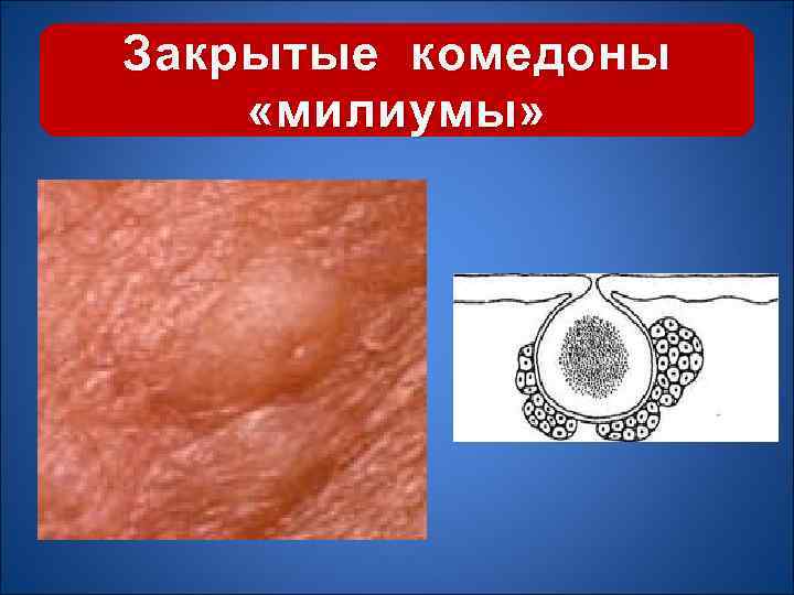 Закрытые комедоны «милиумы» 