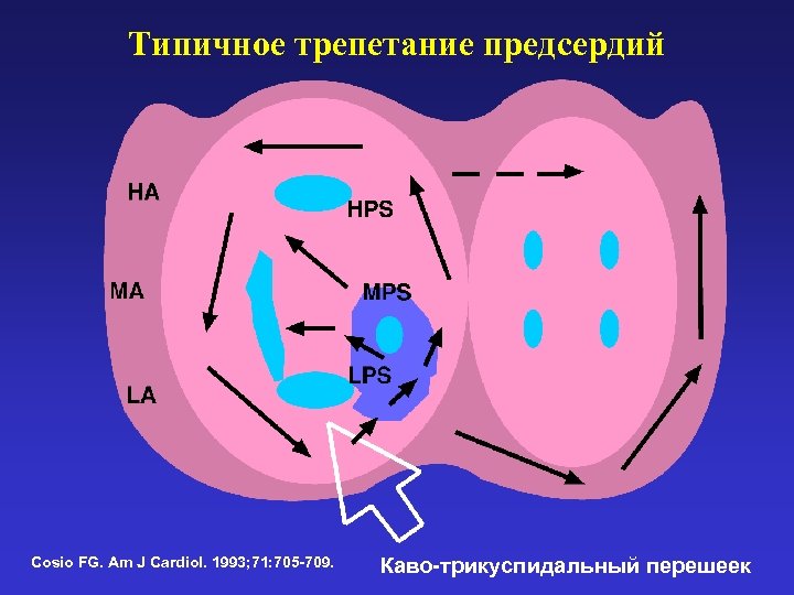 Типичное трепетание предсердий Cosio FG. Am J Cardiol. 1993; 71: 705 -709. Каво-трикуспидальный перешеек