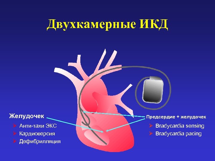 Двухкамерные ИКД Желудочек Ø Анти-тахи ЭКС Ø Кардиоверсия Ø Дефибрилляция Предсердие + желудочек Ø