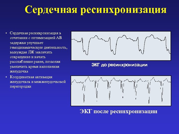 Сердечная ресинхронизация • Сердечная ресинхронизация в сочетании с оптимизацией АВ задержки улучшает гемодинамическую деятельность,