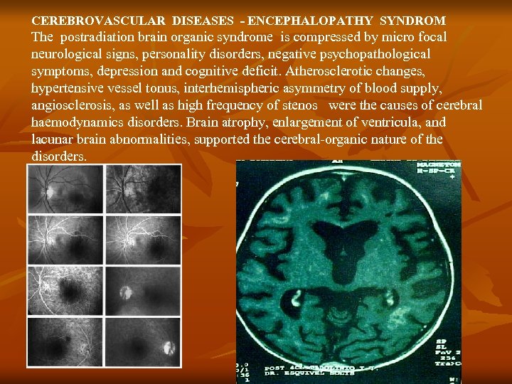 CEREBROVASCULAR DISEASES - ENCEPHALOPATHY SYNDROM The postradiation brain organic syndrome is compressed by micro