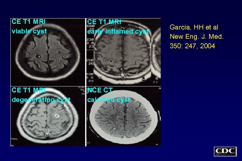 CE T 1 MRI viable cyst CE T 1 MRI early inflamed cyst CE