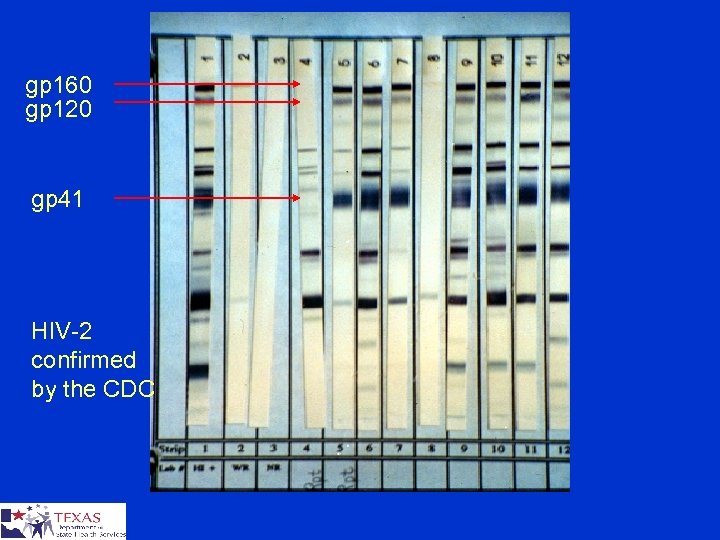 gp 160 gp 120 gp 41 HIV-2 confirmed by the CDC 