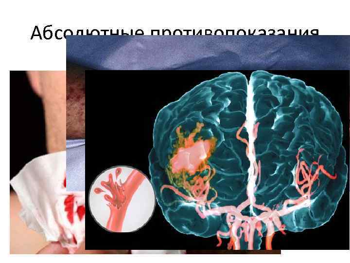 Абсолютные противопоказания 