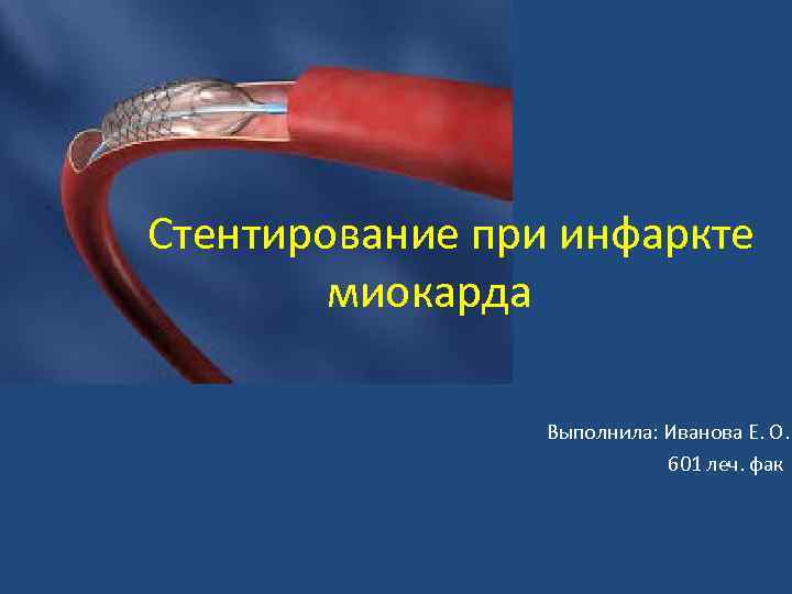  Стентирование при инфаркте миокарда Выполнила: Иванова Е. О. 601 леч. фак 