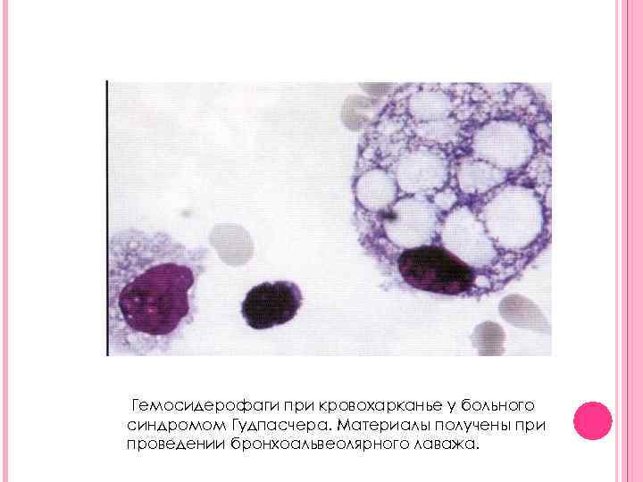 Гемосидерофаги при кровохарканье у больного синдромом Гудпасчера. Материалы получены при проведении бронхоальвеолярного лаважа. 