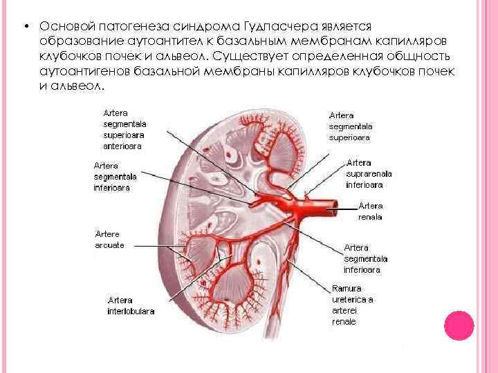  • Основой патогенеза синдрома Гудпасчера является образование аутоантител к базальным мембранам капилляров клубочков