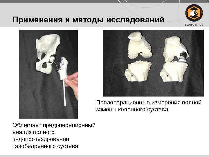 Применения и методы исследований Предоперационные измерения полной замены коленного сустава Облегчает предоперационный анализ полного