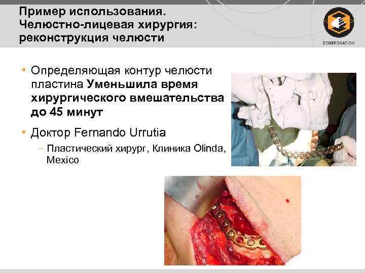 Пример использования. Челюстно-лицевая хирургия: реконструкция челюсти • Определяющая контур челюсти пластина Уменьшила время хирургического