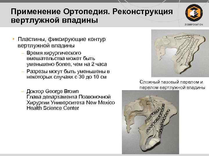 Применение Ортопедия. Реконструкция вертлужной впадины • Пластины, фиксирующие контур вертлужной впадины – Время хирургического