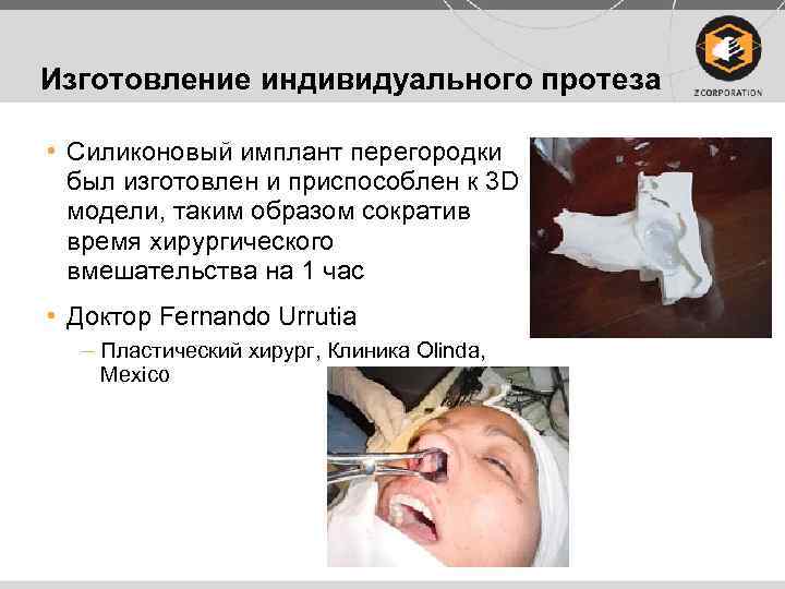 Изготовление индивидуального протеза • Силиконовый имплант перегородки был изготовлен и приспособлен к 3 D