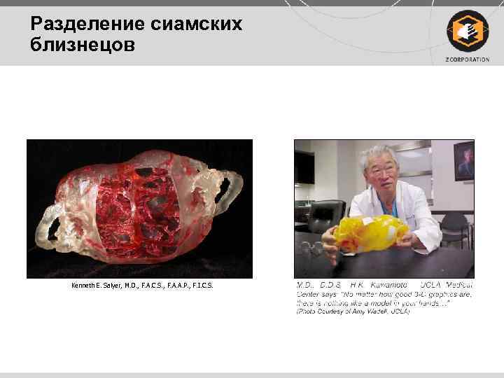 Разделение сиамских близнецов Kenneth E. Salyer, M. D. , F. A. C. S. ,
