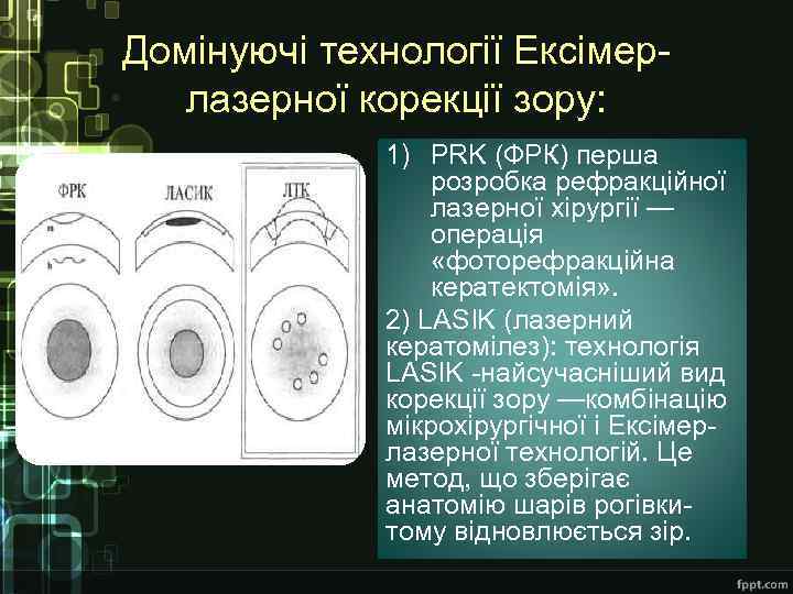 Домінуючі технології Ексімерлазерної корекції зору: 1) PRK (ФРК) перша розробка рефракційної лазерної хірургії —