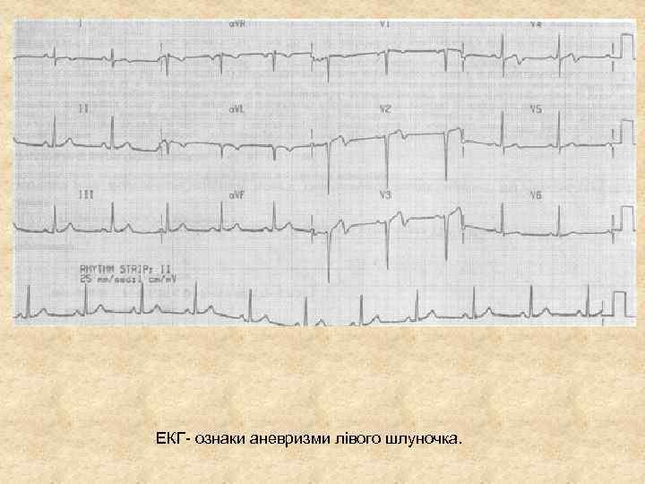 ЕКГ- ознаки аневризми лівого шлуночка. 