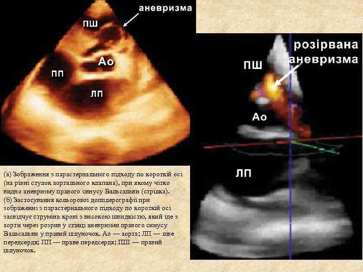 (а) Зображення з парастернального підходу по короткій осі (на рівні стулок аортального клапана), при