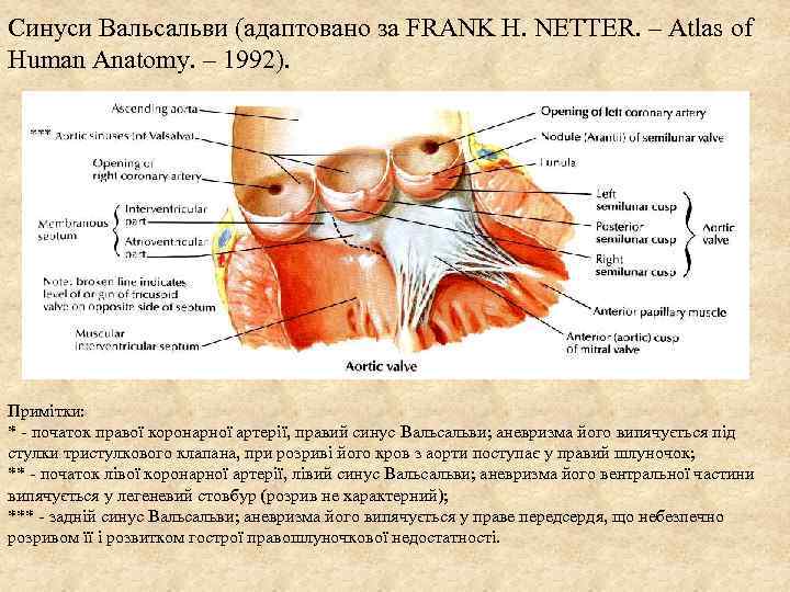 Синуси Вальсальви (адаптовано за FRANK H. NETTER. – Аtlas of Human Anatomy. – 1992).