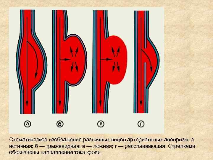 Схематическое изображение различных видов артериальных аневризм: а — истинная; б — грыжевидная; в —